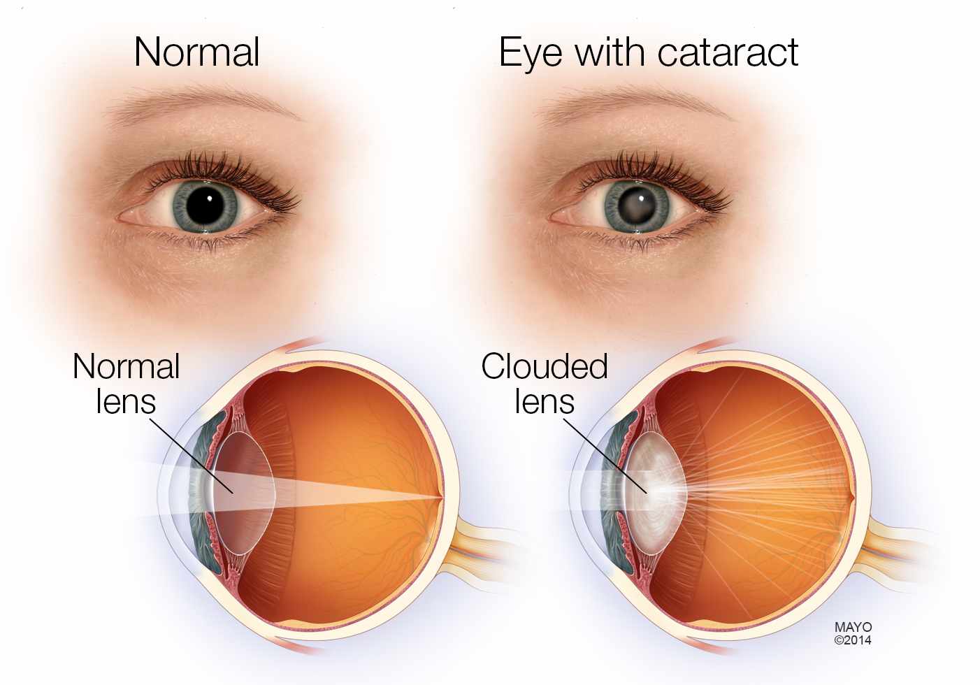 Cataract Surgery at Lakeland Surgical & Diagnostic Center ...