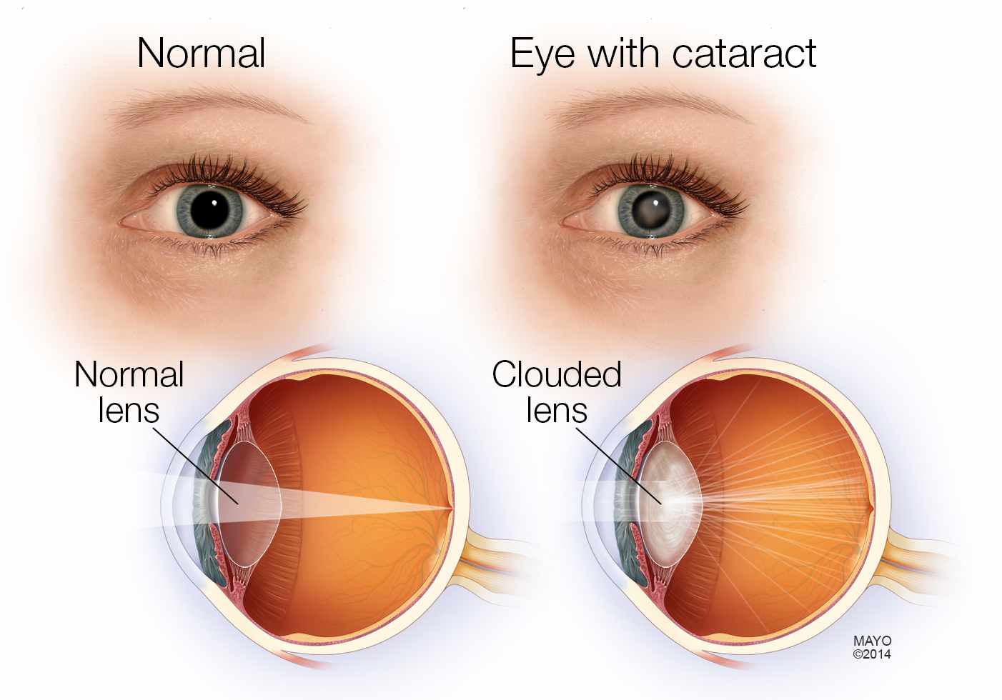 Cataract Surgery Without Eye Drops at Aaron Freese blog