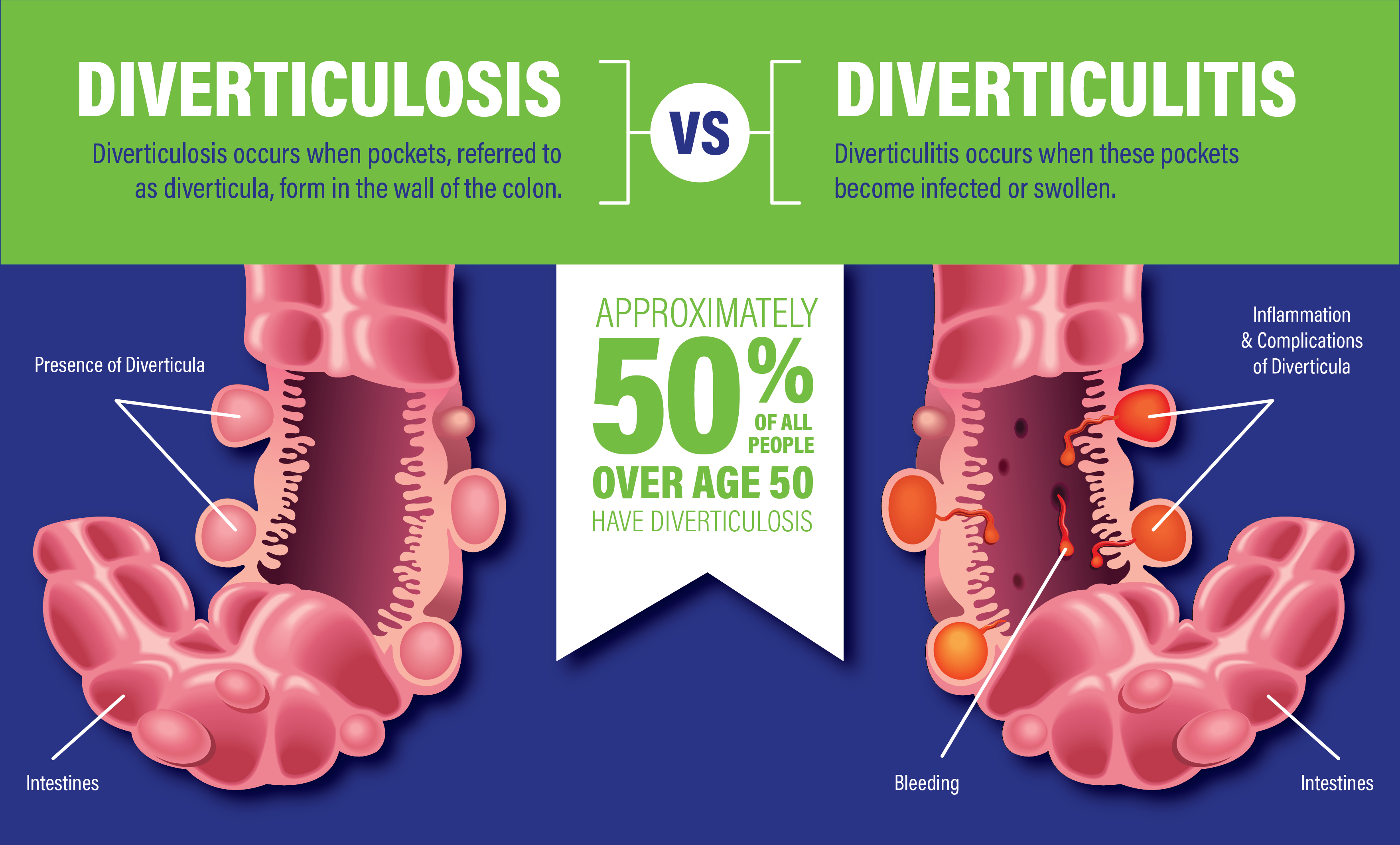 what are the symptoms of diverticulitis