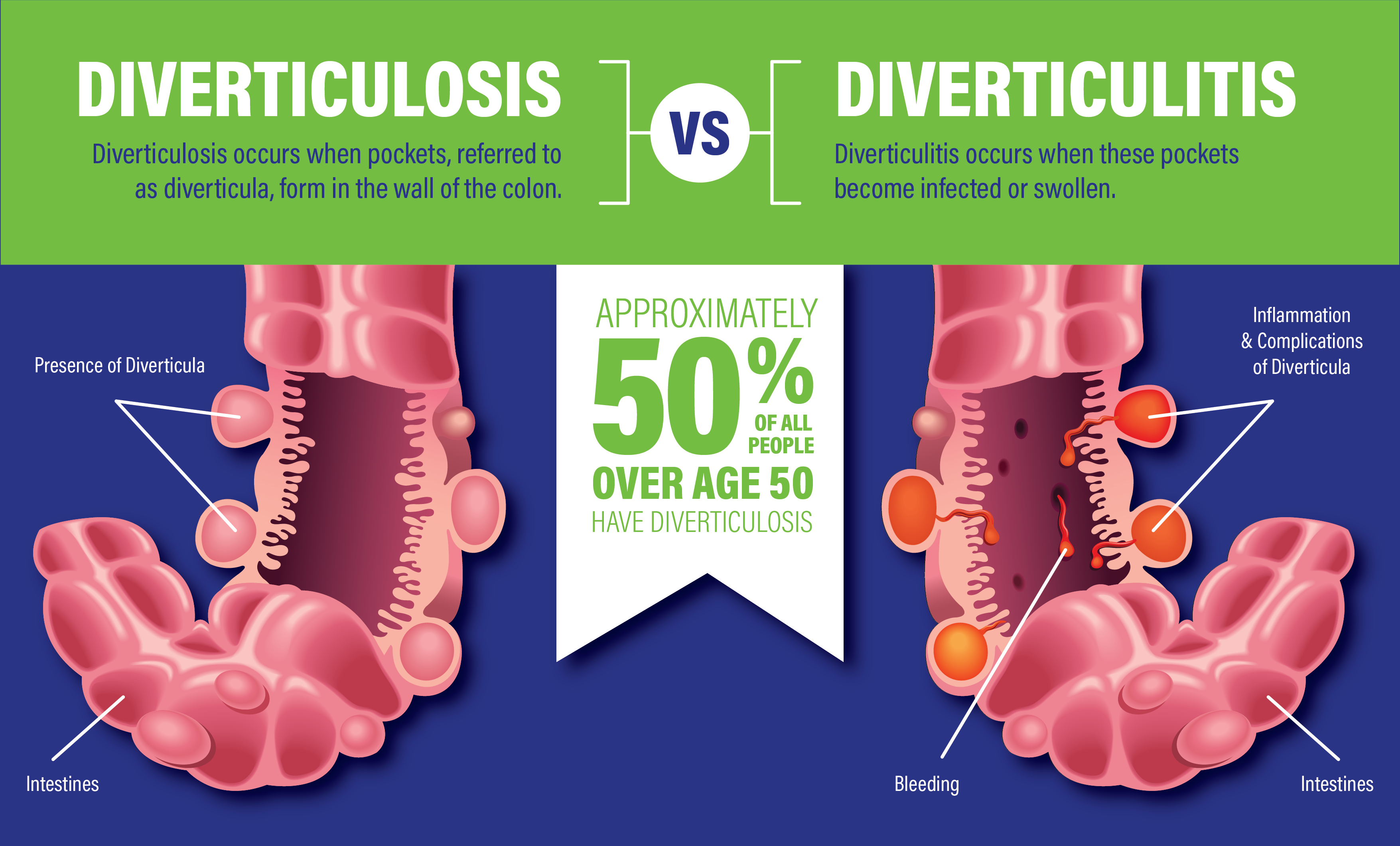 What's the Difference Between Diverticulitis and Diverticulosis?